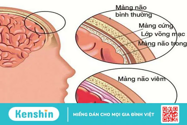 Triệu chứng của bệnh quai bị