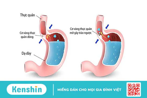 Triệu chứng của bệnh trào ngược dạ dày thực quản