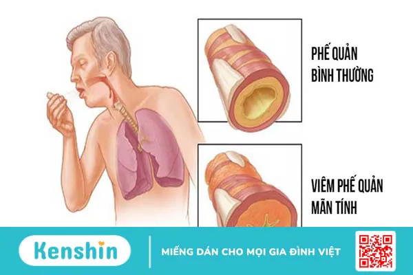 Triệu chứng của bệnh trào ngược dạ dày thực quản