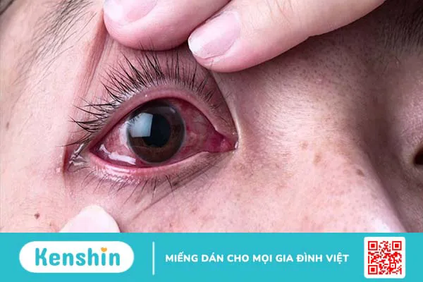 Triệu chứng đau mắt đỏ thường gặp giúp bạn nhận biết bệnh chính xác