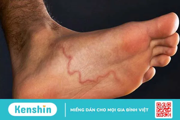 Triệu chứng nhiễm giun bạn cần biết để phát hiện bệnh kịp thời