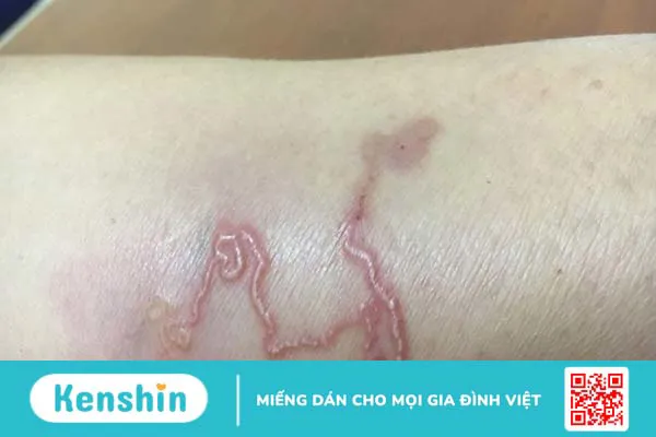 Triệu chứng nhiễm giun bạn cần biết để phát hiện bệnh kịp thời