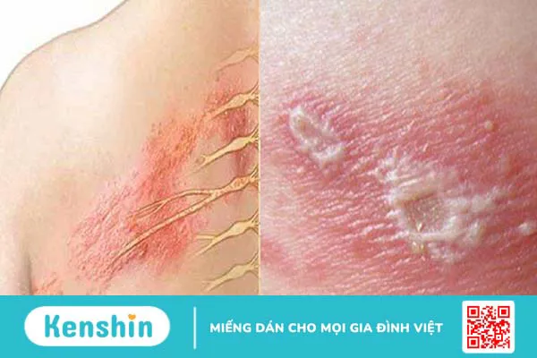 Triệu chứng zona thần kinh (giời leo) giúp bạn nhận biết bệnh