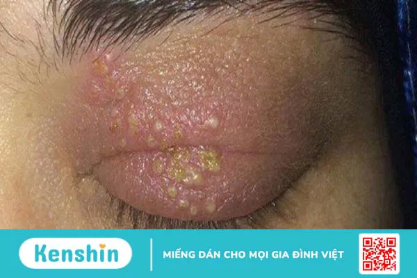 Triệu chứng zona thần kinh (giời leo) giúp bạn nhận biết bệnh