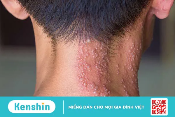 Triệu chứng zona thần kinh (giời leo) giúp bạn nhận biết bệnh