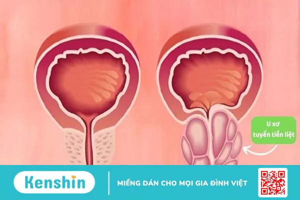 Trinh nữ hoàng cung có tác dụng gì? Công dụng và liều dùng