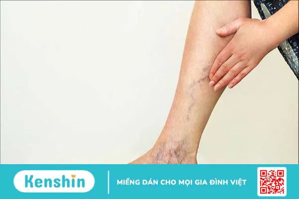 Tư thế ngủ cho người suy giãn tĩnh mạch bạn không nên bỏ qua