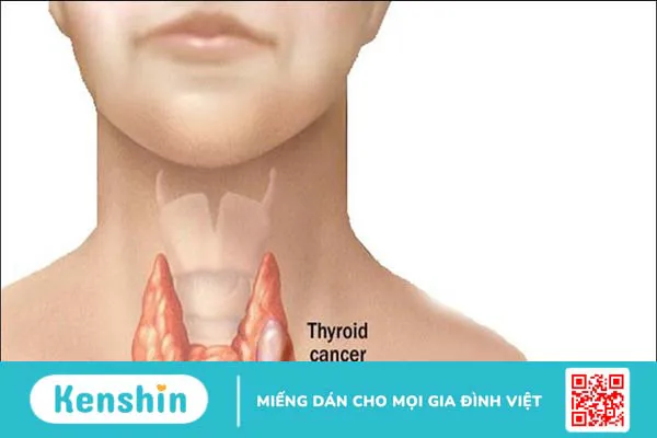 Tuyến giáp là gì? 6 bệnh tuyến giáp thường gặp nhất