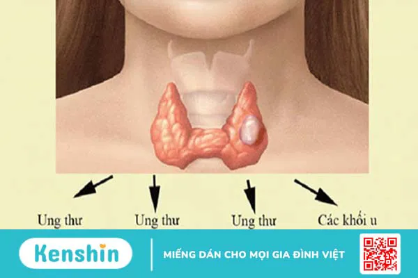 Tuyến giáp là gì? 6 bệnh tuyến giáp thường gặp nhất