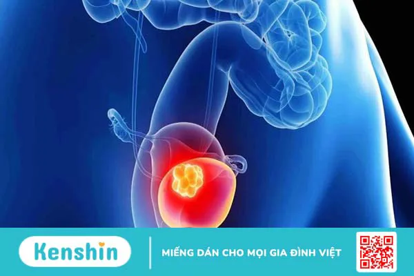 Ung thư bàng quang sống được bao lâu?