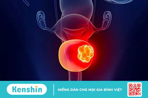 Ung thư bàng quang sống được bao lâu?