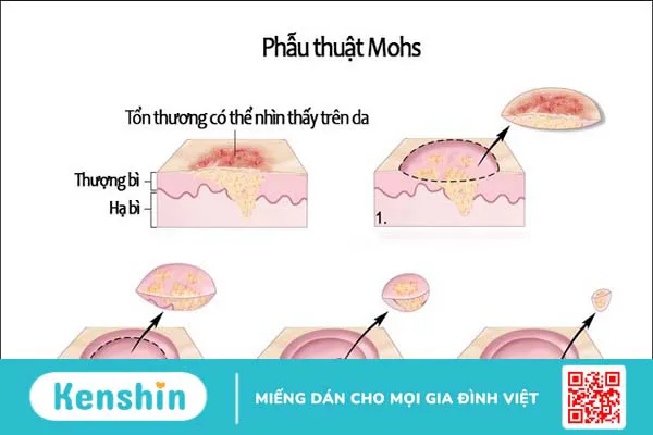 Ung thư da có chữa được không? Lưu ý khi điều trị ung thư da