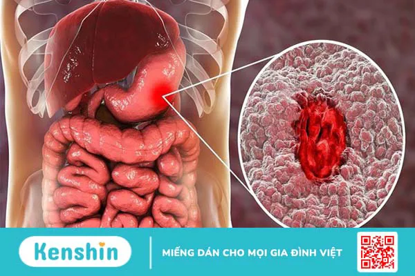 Ung thư dạ dày có chữa được không và các phương pháp điều trị hiện nay