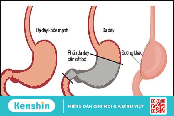 Ung thư dạ dày có chữa được không và các phương pháp điều trị hiện nay