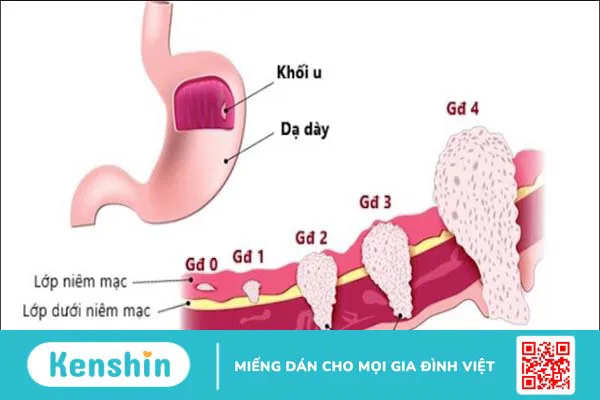 Ung thư dạ dày sống được bao lâu?