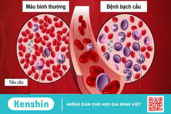 Ung thư máu có di truyền không? 6 dấu hiệu và yếu tố nguy cơ