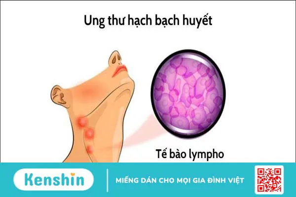 Ung thư máu có di truyền không? 6 dấu hiệu và yếu tố nguy cơ