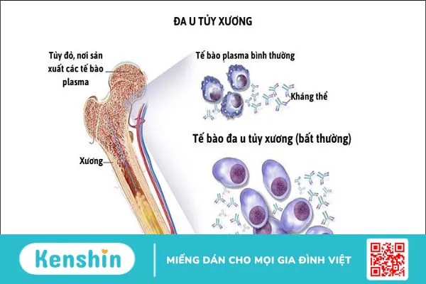 Ung thư máu có di truyền không? 6 dấu hiệu và yếu tố nguy cơ