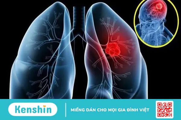 Ung thư phổi giai đoạn cuối sống được bao lâu? Cách chăm sóc bệnh nhân