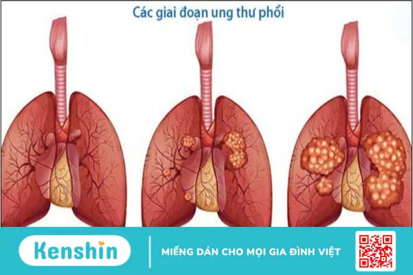 Ung thư phổi giai đoạn cuối sống được bao lâu? Cách chăm sóc bệnh nhân