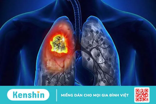 Ung thư phổi giai đoạn cuối sống được bao lâu? Cách chăm sóc bệnh nhân