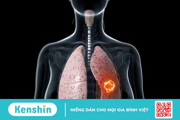 Ung thư phổi giai đoạn cuối sống được bao lâu? Cách chăm sóc bệnh nhân