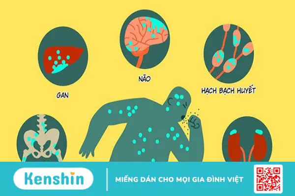 Ung thư phổi giai đoạn cuối sống được bao lâu? Cách chăm sóc bệnh nhân