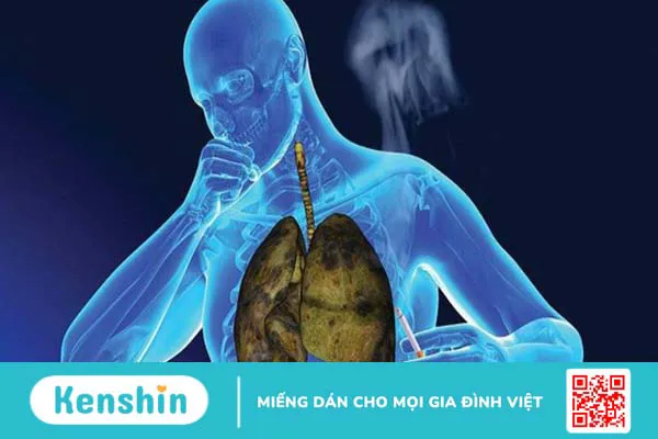 Ung thư phổi giai đoạn cuối sống được bao lâu? Cách chăm sóc bệnh nhân