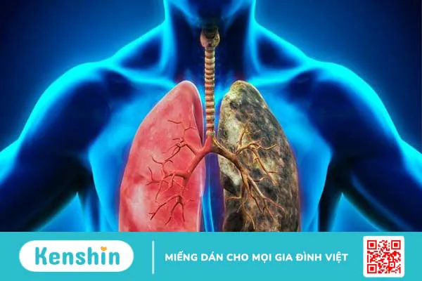 Ung thư phổi giai đoạn cuối sống được bao lâu? Cách chăm sóc bệnh nhân