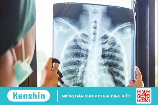 Ung thư phổi giai đoạn cuối sống được bao lâu? Cách chăm sóc bệnh nhân