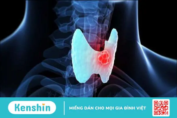 Ung thư tuyến giáp có chữa được không? Phương pháp điều trị ung thư tuyến giáp