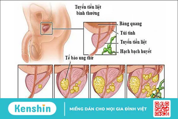 Ung thư tuyến tiền liệt sống được bao lâu?