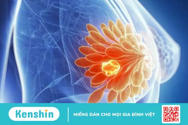 Ung thư vú nên ăn gì và kiêng ăn gì? Lời khuyên dành cho người bệnh