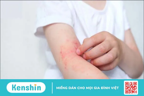 Vắc xin thủy đậu phải tiêm bao nhiêu mũi và nên tiêm khi nào?