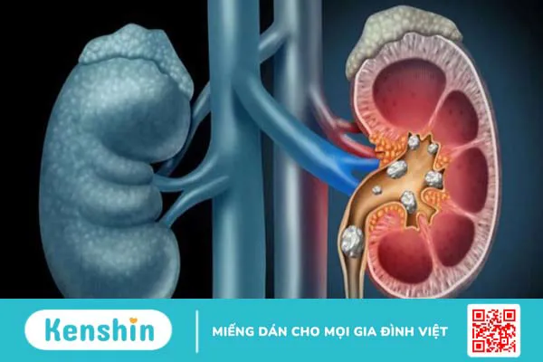 Vị trí thận nằm ở đâu trong cơ thể? Cấu tạo và chức năng của thận