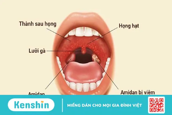 Viêm họng hạt có lây không? Con đường lây lan và cách phòng ngừa