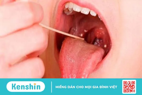 Viêm họng nên ăn gì? Các loại thực phẩm giúp bạn nhanh hết viêm họng