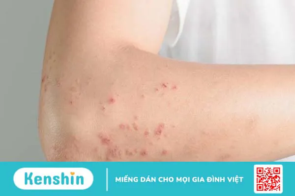 Viêm tai giữa có lây không? Cách phòng ngừa bệnh viêm tai giữa