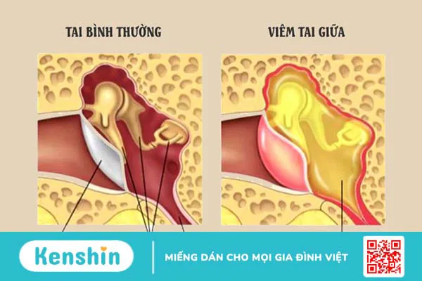 Viêm tai giữa có tự khỏi được không và bao lâu thì khỏi?