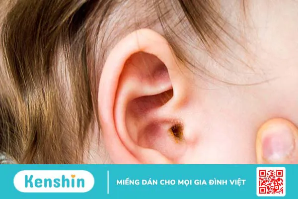 Viêm tai giữa có tự khỏi được không và bao lâu thì khỏi?