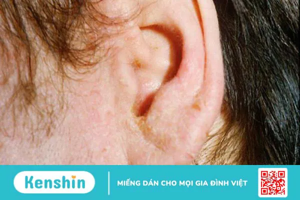 Viêm tai ngoài có tự khỏi không và bao lâu thì khỏi?