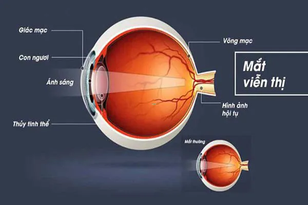 Viễn thị có khác lão thị? Nguyên nhân và cách điều trị viễn thị