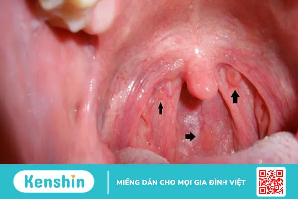 Virus HPV có thể gây ra bệnh gì?