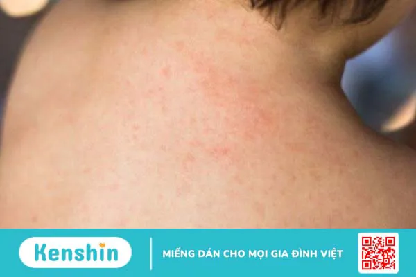 Vitamin B10 (PABA) là gì? Công dụng, cách dùng, tác dụng phụ