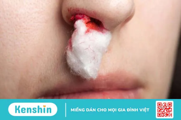 Xì mũi ra máu là bệnh gì? Có nguy hiểm không?