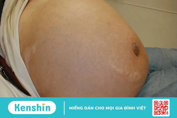 10 biến chứng xơ gan bạn không nên xem thường