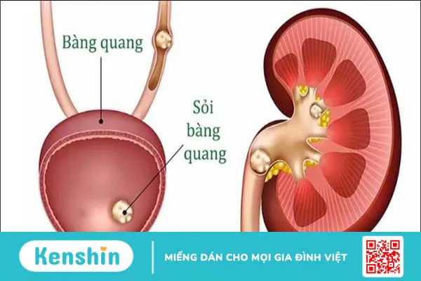 10 cách trị sỏi bàng quang dân gian hiệu quả, đơn giản tại nhà