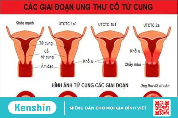 10 dấu hiệu ung thư cổ tử cung chị em không nên bỏ qua