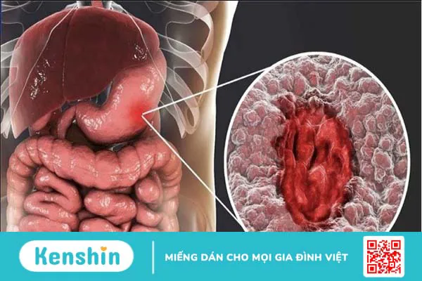 13 nguyên nhân gây ung thư dạ dày được các chuyên gia cảnh báo!