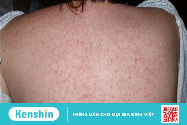 13 nguyên nhân phát ban da và cách khắc phục bạn cần nên biết